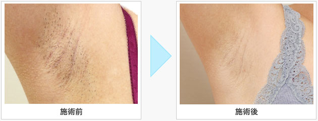 蓄熱式医療脱毛レーザー